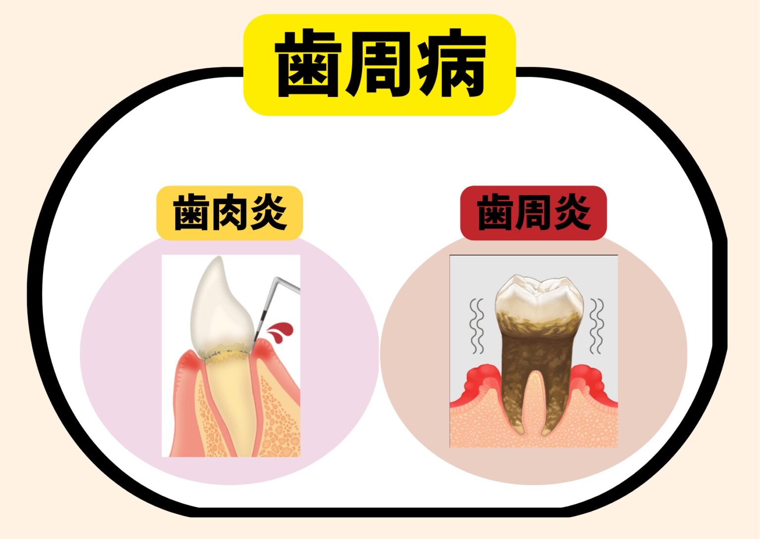 【初心に戻ろう!】歯科衛生士がおさえておきたい歯肉炎・歯周病の基本のキ | 歯科衛生士の自習室 | さとじむ